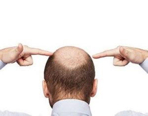 Revifol Hair Loss Reviews - Any Side Effects?