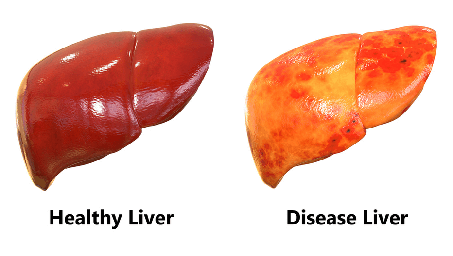 The Non-Alcoholic Fatty Liver Disease Solution Download